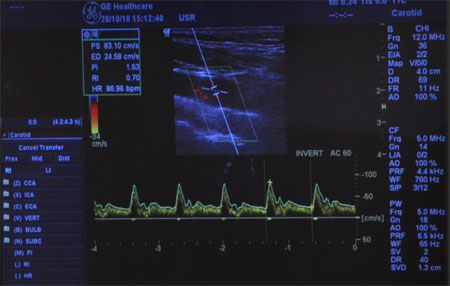 duplexni - ultrasonografie