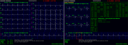 Ekg vyšetření