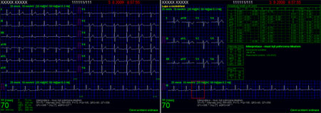 elektrokardiografické vyšetření